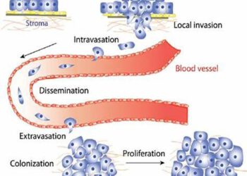 Chặn đường di căn ung thư bằng thảo dược chiết cồn: hiểu đúng – làm được