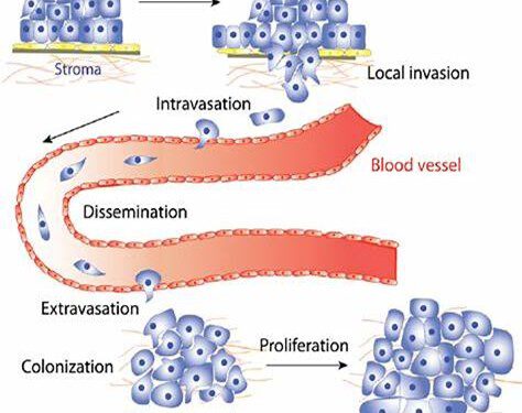 Chặn đường di căn ung thư bằng thảo dược chiết cồn: hiểu đúng – làm được