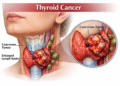 Giới thiệu bài thuốc phòng chống di căn, di cư sau phẫu thuật ung thư tuyến giáp