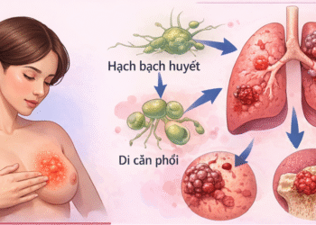 Ba vị thuốc nam và giả thuyết ngăn ngừa, hạn chế tái phát ung thư vú sau điều trị chuẩn
