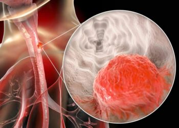 Mẹo giảm tái phát ung thư thực quản sau khi kết thúc điều trị: Thạch hộc, Dâm dương hoắc, Tadalafil – góc nhìn tích hợp