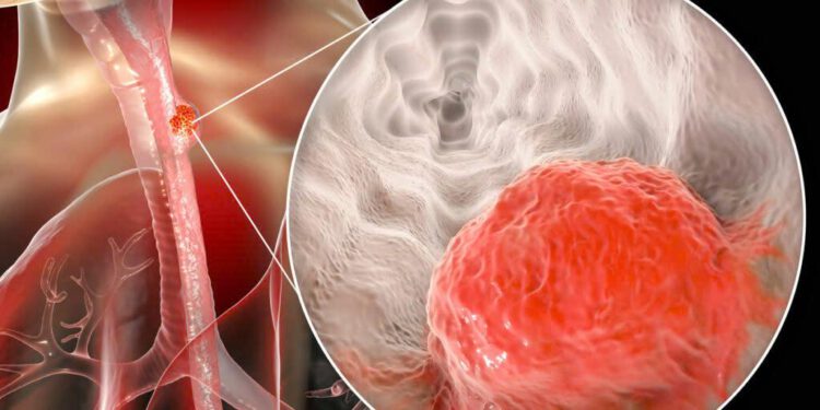 Mẹo giảm tái phát ung thư thực quản sau khi kết thúc điều trị: Thạch hộc, Dâm dương hoắc, Tadalafil – góc nhìn tích hợp