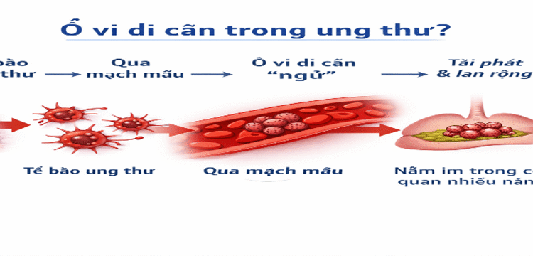 Ổ vi di căn trong ung thư là gì?