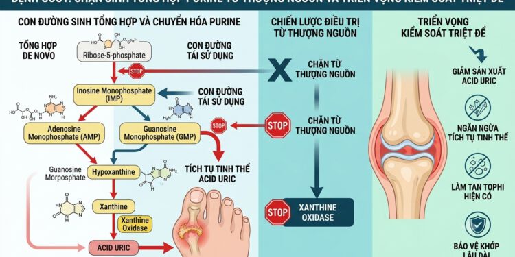 Bệnh gout: Chặn sinh tổng hợp purine từ thượng nguồn và triển vọng kiểm soát triệt để bệnh gout